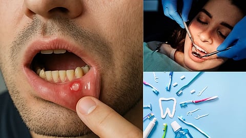 Mouth ulcer symptoms
