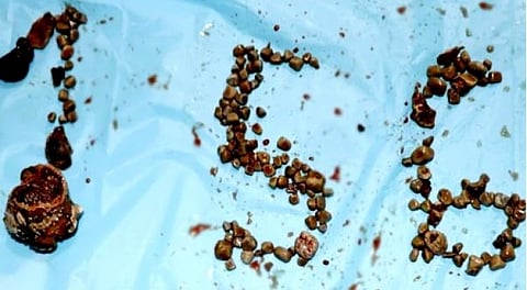 சிறுநீரக உறுப்பிலிருந்து நோயாளி ஒருவருக்கு அகற்றப்பட்ட 156 கற்கள்!