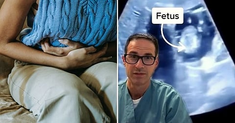 பெண்ணின் கல்லீரலில் வளர்ந்த கருவை கண்டு மருத்துவர்கள் அதிர்ச்சி!