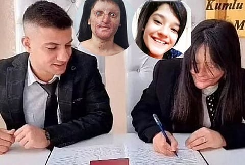 ஆசிட் வீசிய காதலனையே கைப்பிடித்த இளம்பெண்!