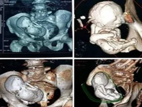 35 ஆண்டுகளாக வயிற்றில் ஒரு கல் குழந்தையுடன் வாழ்ந்து வந்த மூதாட்டி : அதிர்ந்துபோன மருத்துவர்கள்!