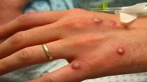 முதல் குரங்கு அம்மை காய்ச்சலைப் பதிவு செய்தது இந்தியா: