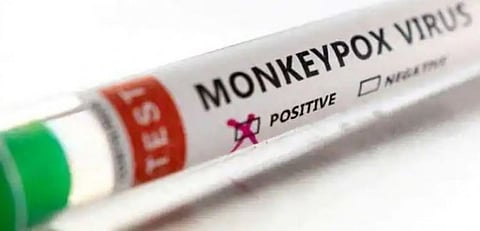 தலைநகரில் முதல் குரங்கம்மை பாதிப்பு...! உறுதி செய்த சுகாதார துறை அமைச்சகம் ..!