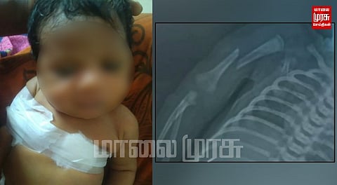 பிரசவத்தின் போது பச்சிளம் குழந்தைக்கு கை முறித்த செவிலியர்கள்...