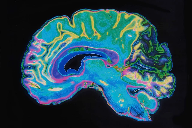 Brain scan of an Alzheimer’s patient (Photo: iStock)
