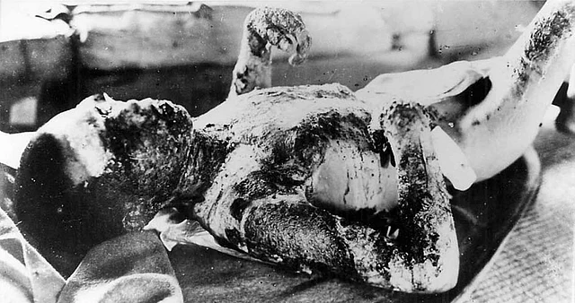 A badly burned nuclear bomb victim from Hiroshima lies in quarantine. 