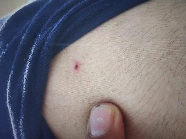 Ibrahim’s pellet injuries 