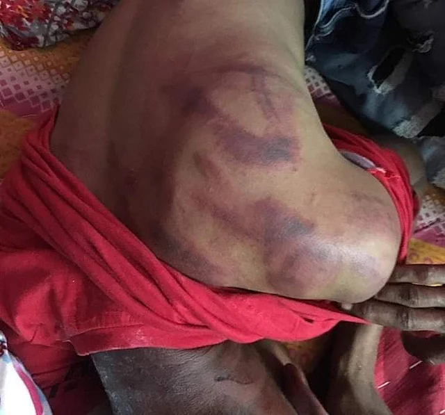 Rahul showing the injury marks as a result of alleged beating by iron rods.