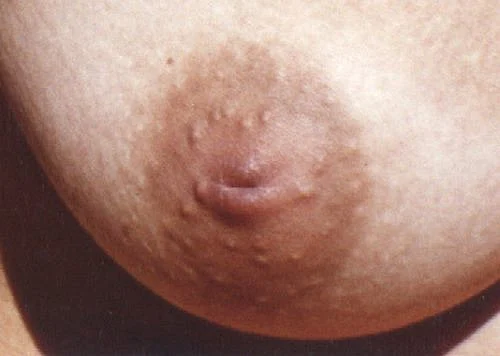 Fibrosis causes shortening of ducts & this imbalance pulls the nipple inwards even when the muscle is trying to make it protrude out.