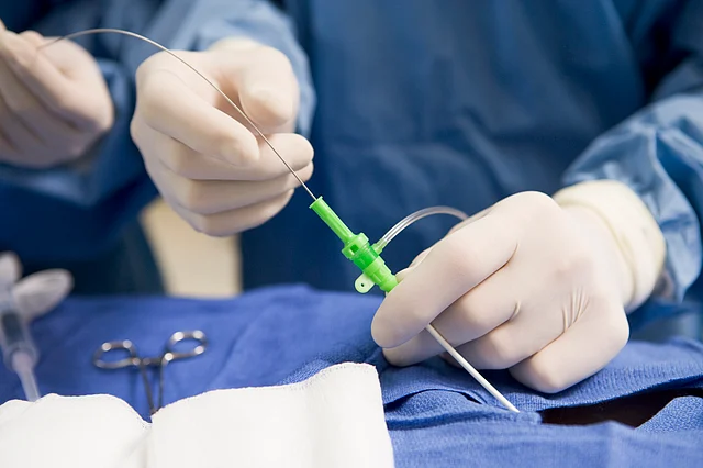 Mechanical thrombectomy (MT) is a minimally-invasive surgery.