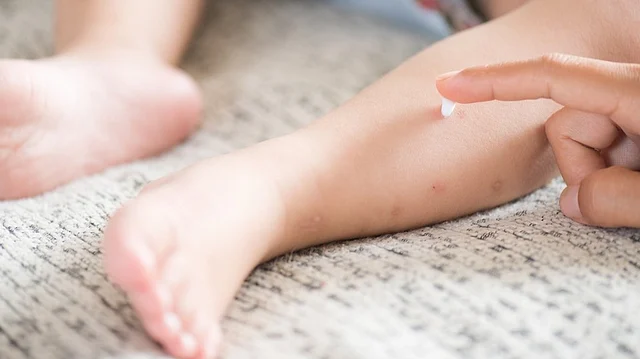Calamine contains zinc oxide which helps reduce red bumps.