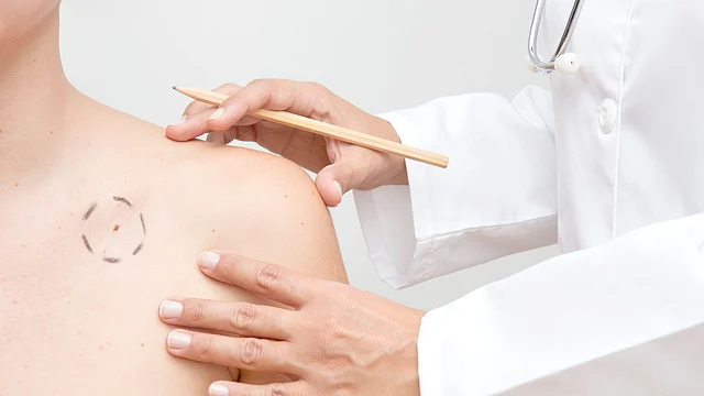 A birthmark is harmless in most cases.