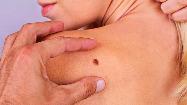 “It is always a better option to visit a doctor in the case of birthmarks,” say experts.