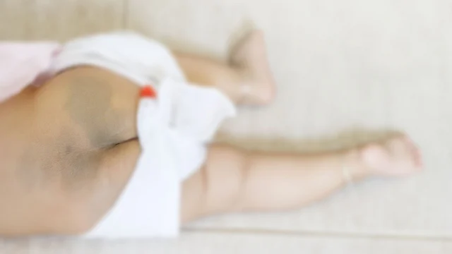 Mongolian spots are bluish-grey spots that usually appear on an infant’s buttocks. 