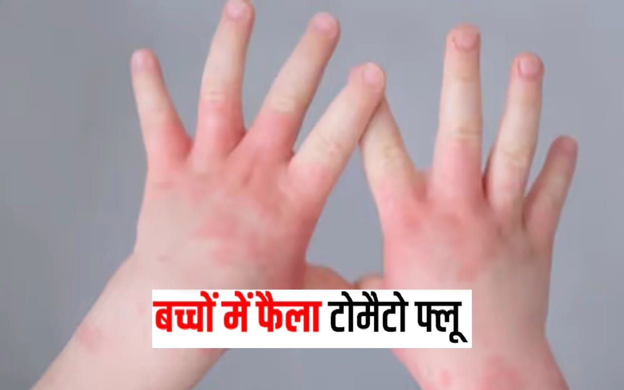 explainer tomato flu outbreak in india know about treatment symptoms and  risk of tomato fever smb | Explainer: भारत में Tomato flu का बढ़ा खतरा,  जानें क्या हैं लक्षण और उपचार?