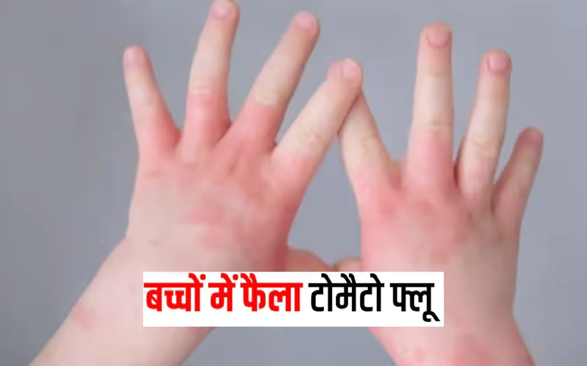 explainer tomato flu outbreak in india know about treatment symptoms and risk of tomato fever smb | Explainer: भारत में Tomato flu का बढ़ा खतरा, जानें क्या हैं लक्षण और उपचार?