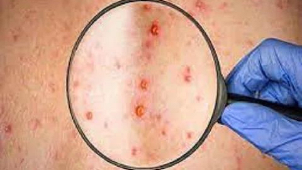 Monkeypox