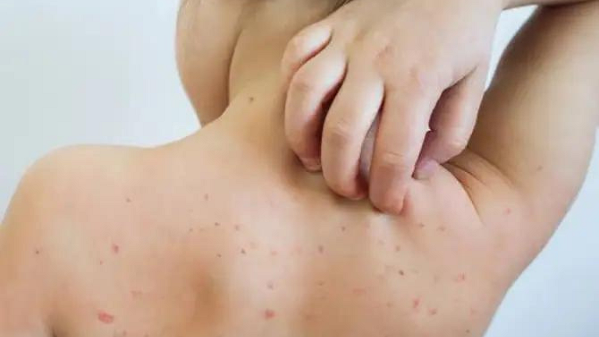 Measles