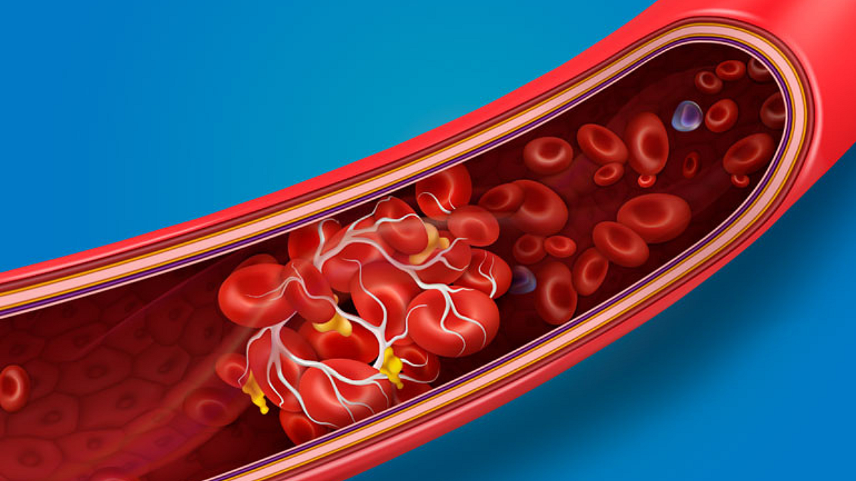 Blood Clots
