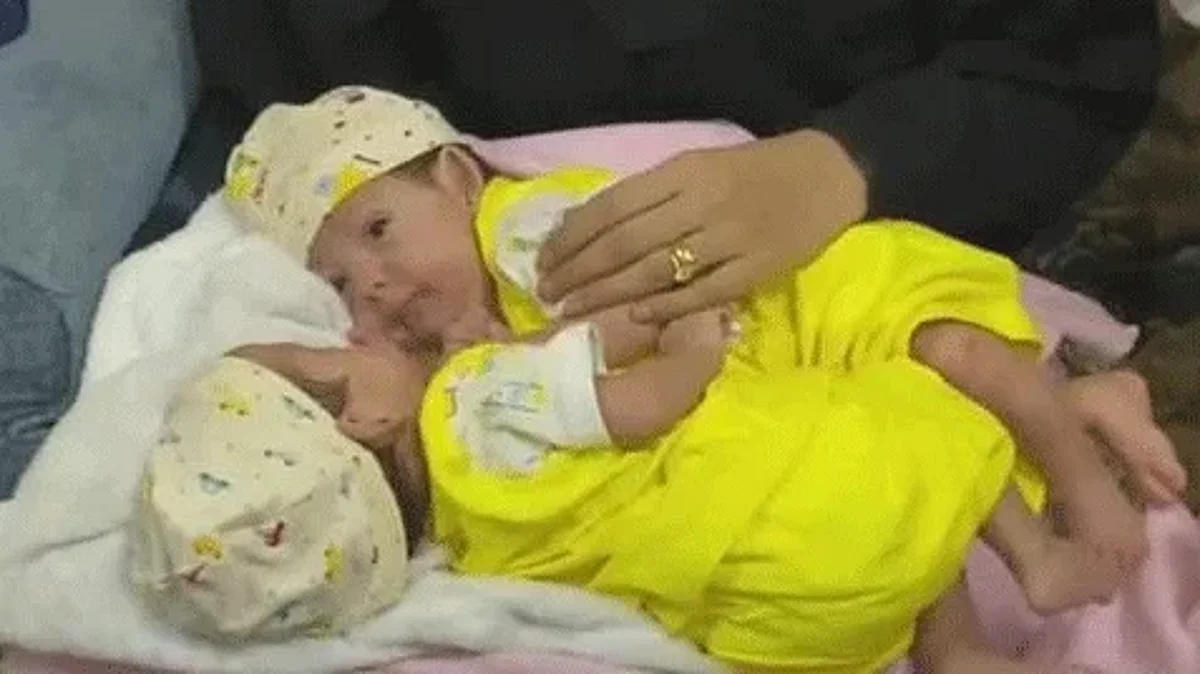 التوأم السيامي مودة ورحمة