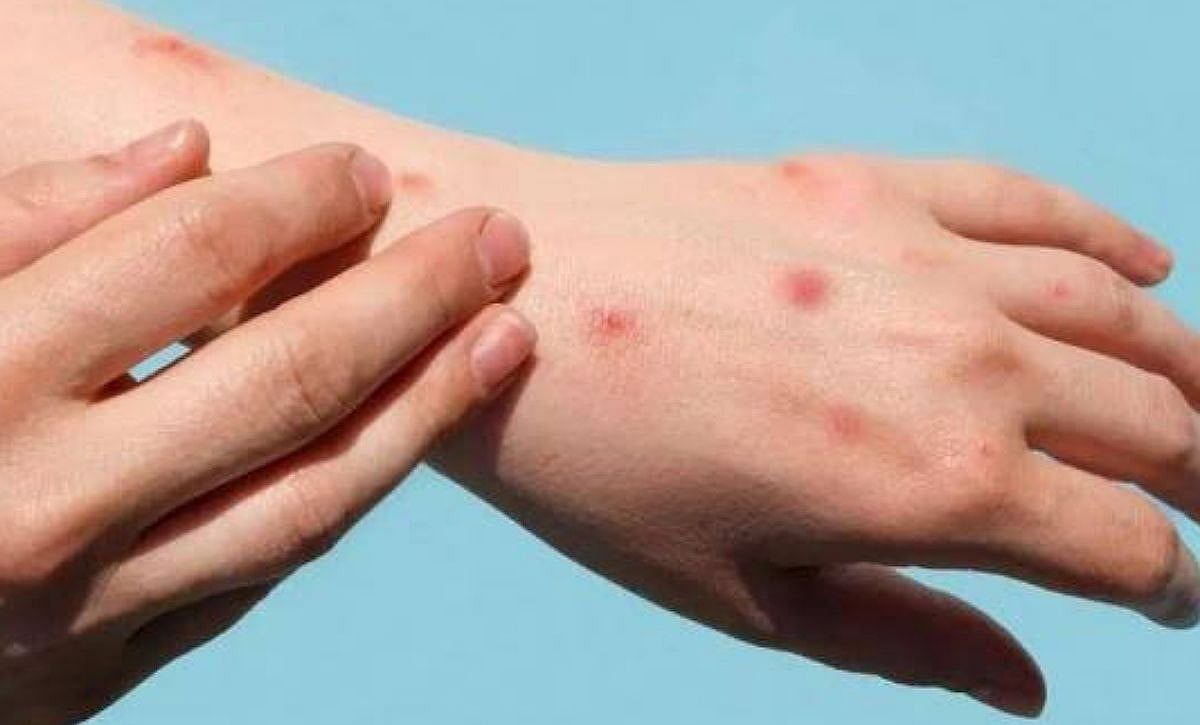 جدري القرود