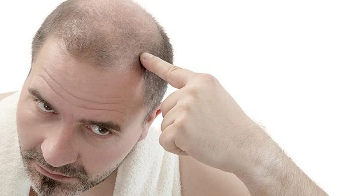 أسباب تساقط الشعر عند الرجل