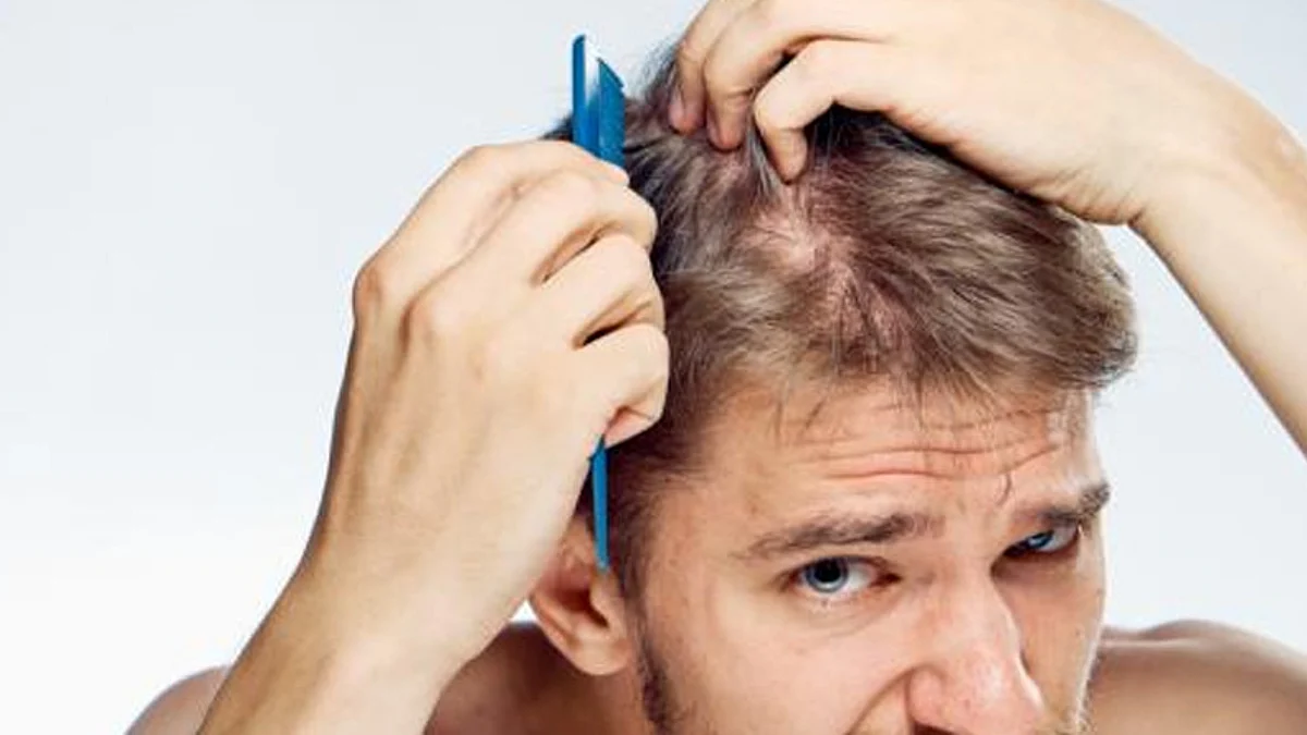اسباب تساقط الشعر عند الرجل