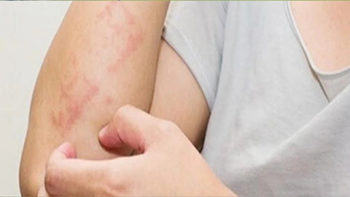 مرضى حساسية القمح