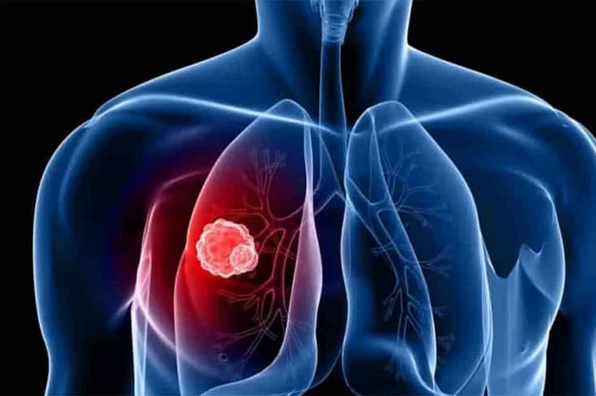عقار أمريكي لعلاج سرطان الرئة يحقق نجاحًا بنسبة 54 بالمئة