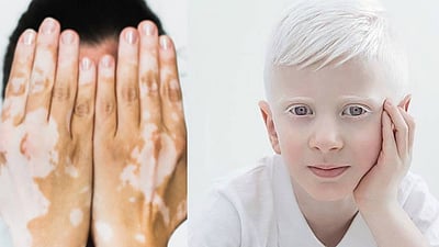 الصحة توضّح الفرق بين مرضي البهاق والمهق على صبغة الجلد