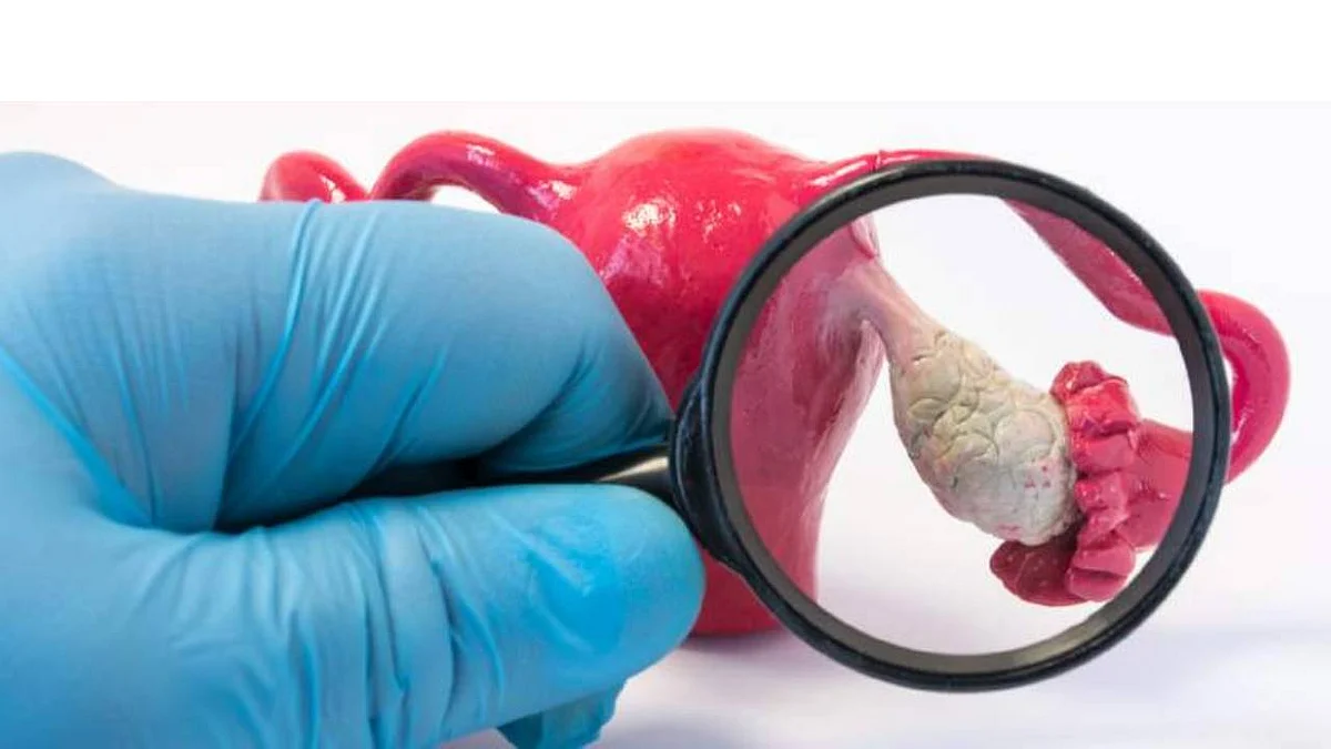 5 طرق لعلاج متلازمة تكيس المبايض.. والنظام الصحي أولوية