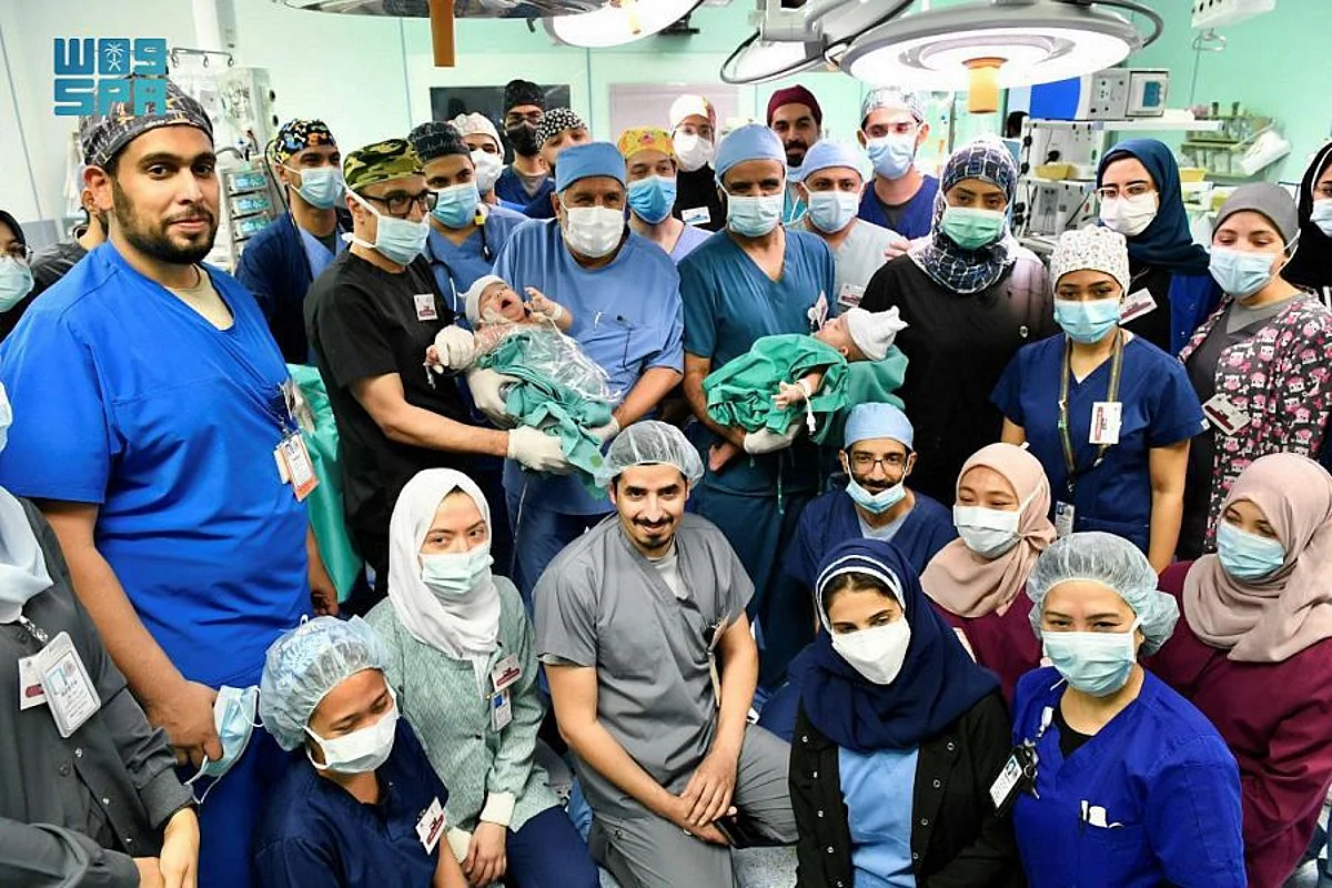 Saudi Arabia adds new achievement to its record of separation of conjoined twins