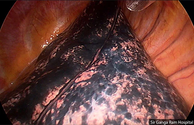 The image of a black lung in a non-smoker and lung cancer patient at Sir Ganga Ram Hospital, Delhi, shows how even young lungs have the appearance of a smoker’s.
