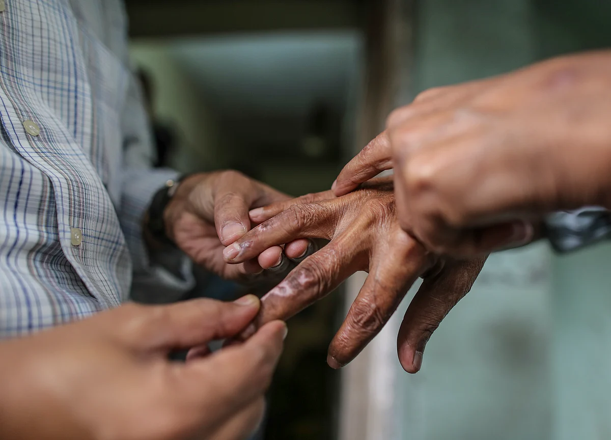 Leprosy Is Making A Comeback In India, But The Government Wants To Deny It