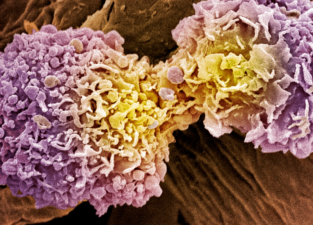 Google Shows AI Can Spot Breast Cancer Better Than Doctors