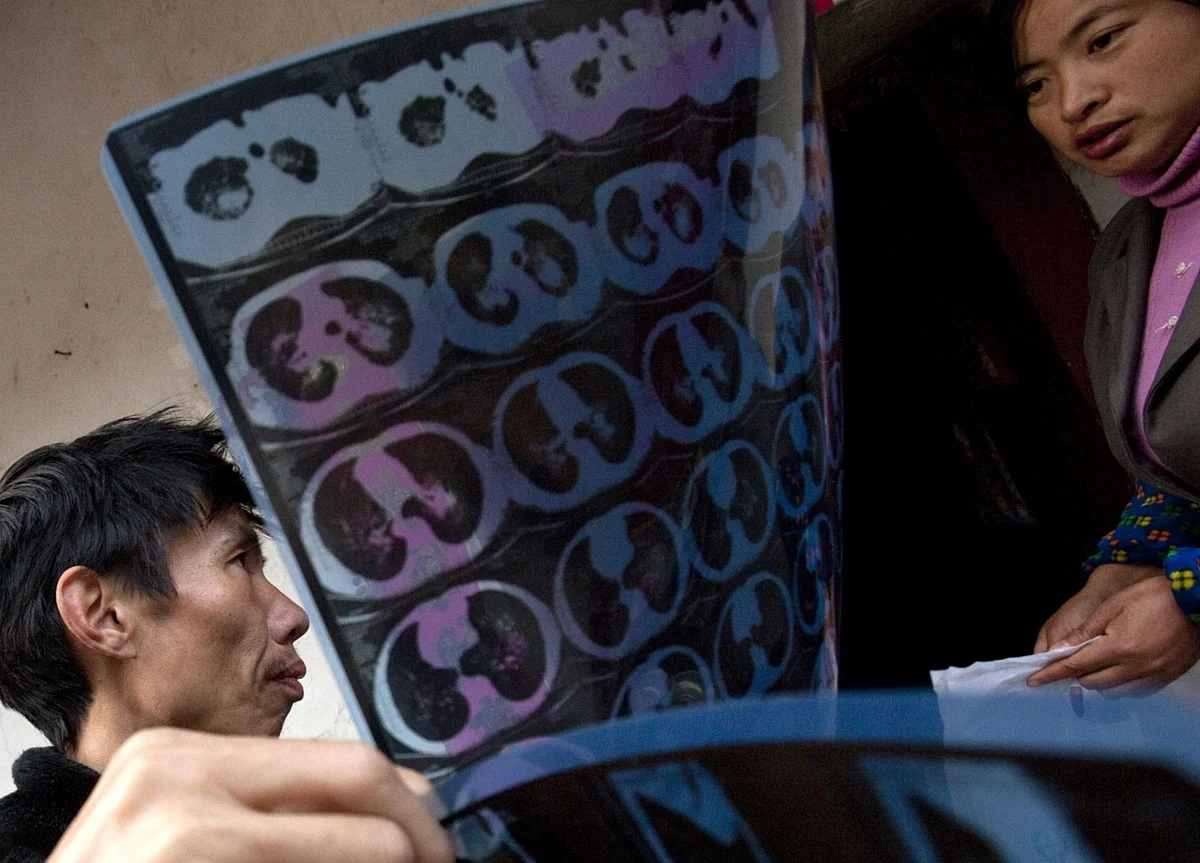 Lung Biopsy of Deceased China Patient Shows SARS-Like Damage