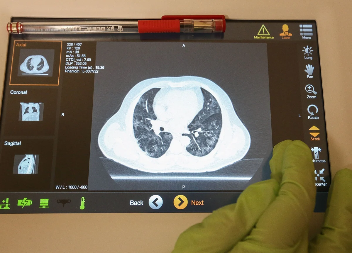 Double-Lung Transplants Rise After Covid ‘Honeycombs’ Organs