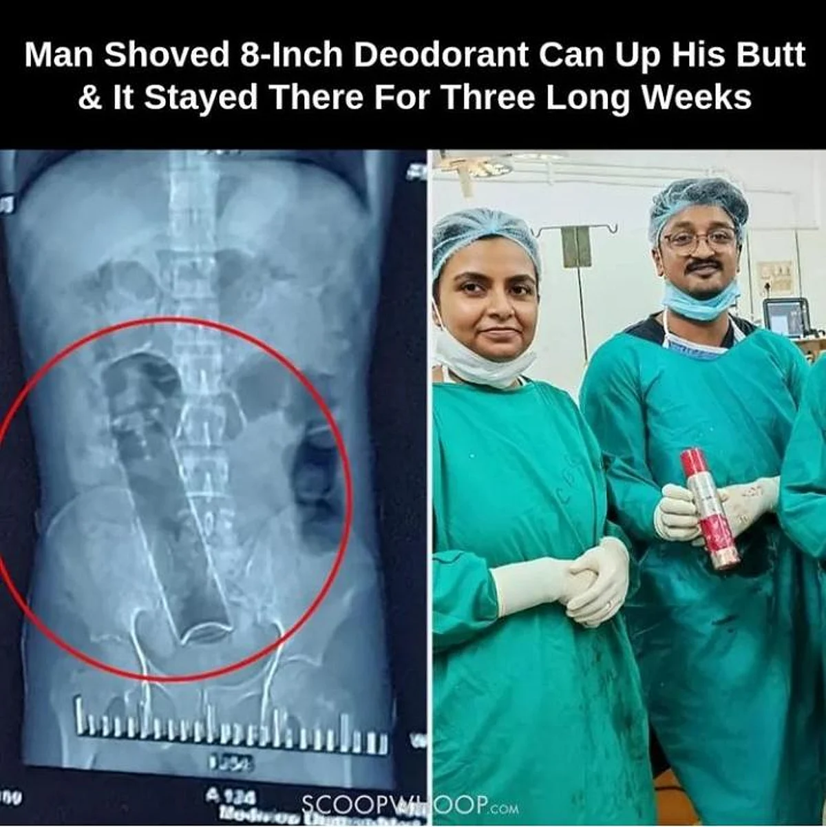 डाक्टरों की टीम ने निकाला Deodorant