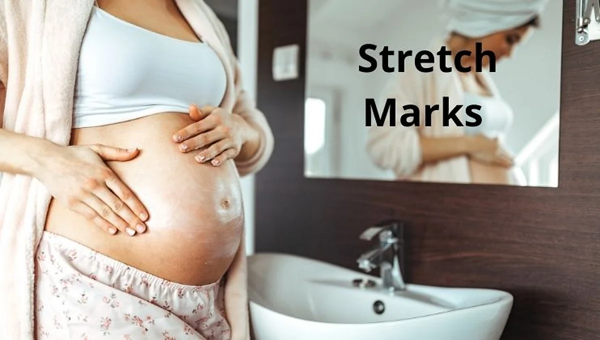 Stretch Marks कमी करण्यासाठी करा हे घरगुती उपाय