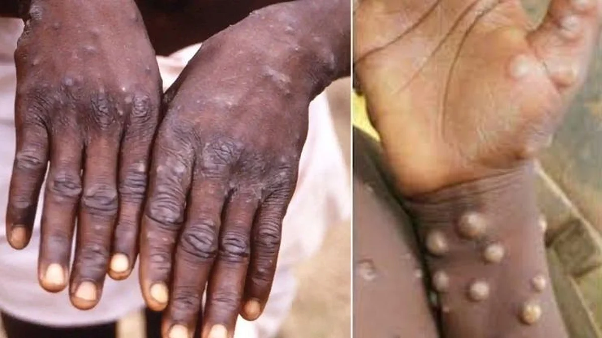 Monkeypox Virus
