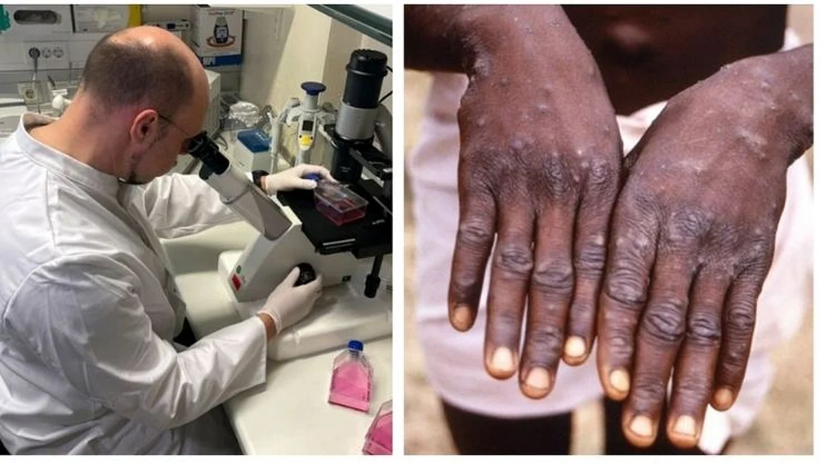 Monkey Pox