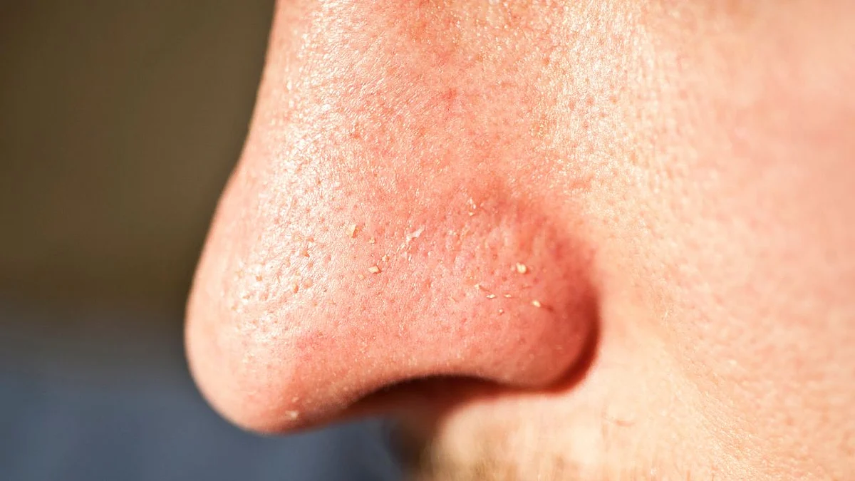 Whiteheads Cure: व्हाइटहेड्सवर जबरदस्त घरगुती उपाय