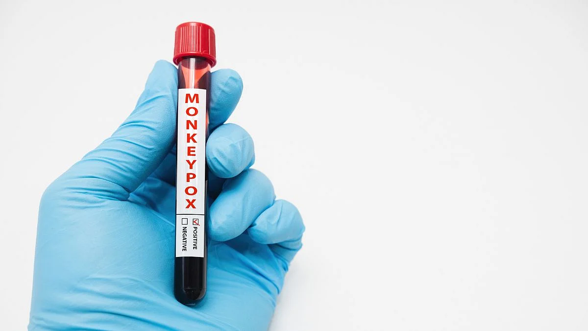 Monkeypox Virus: सेक्स संबंधित मार्गदर्शक तत्त्वे जारी, भारताला सतर्कतेचा इशारा