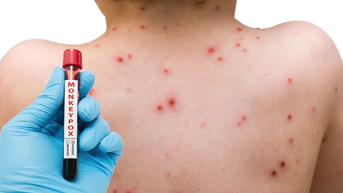 MonkeyPox