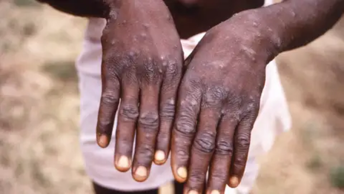 Monkeypox Virus