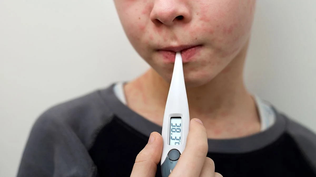 Mumbai News |Measles