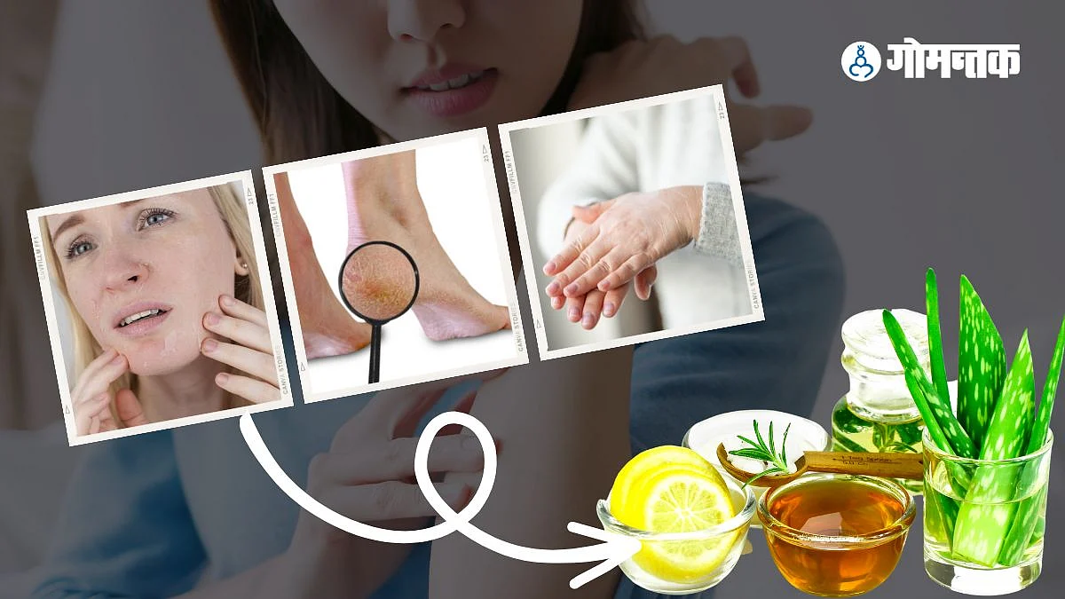 Dry Skin Treatment at Home
