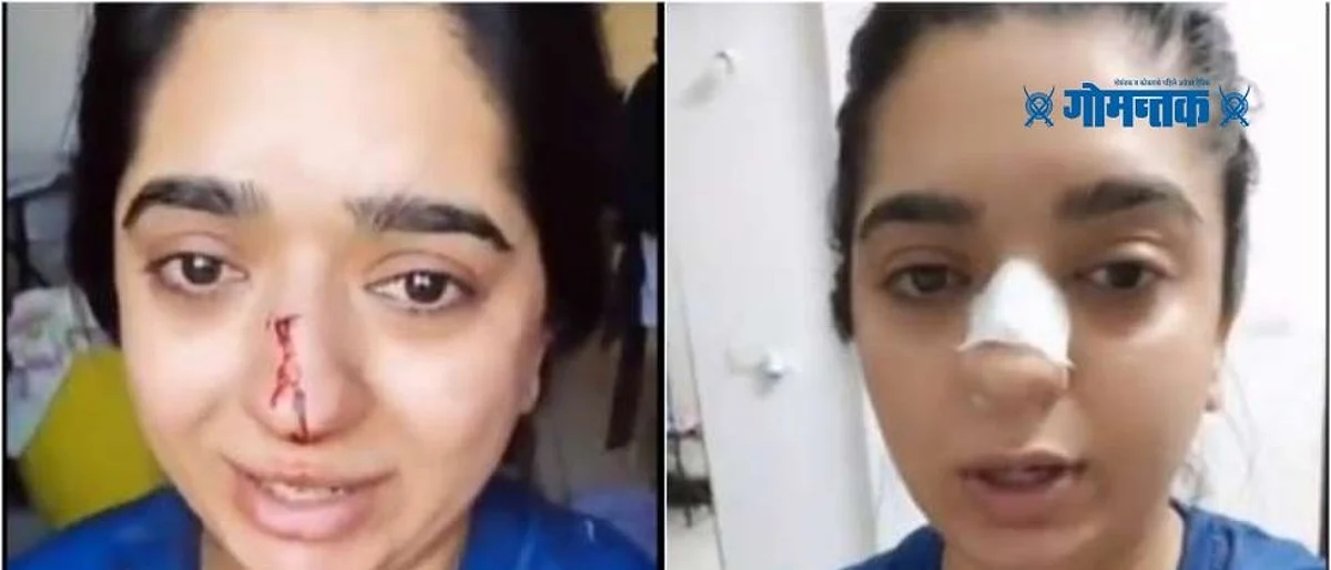 ऑर्डर रद्द केल्य़ामुळे झोमॅटो डिलिव्हरी बॉयने चक्क महिलेचं नाक फोडलं