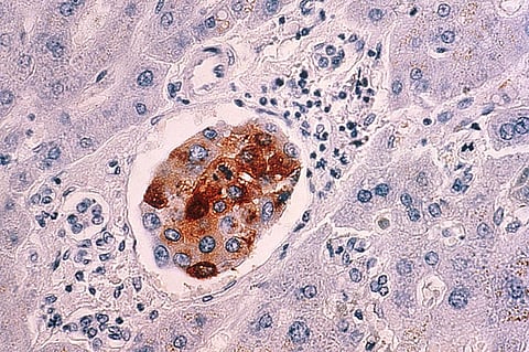 The new study delineates the exact mechanism of resistance in cells from cervical cancer caused by Human Papilloma Virus (HPV). Credit: Wikimedia Commons