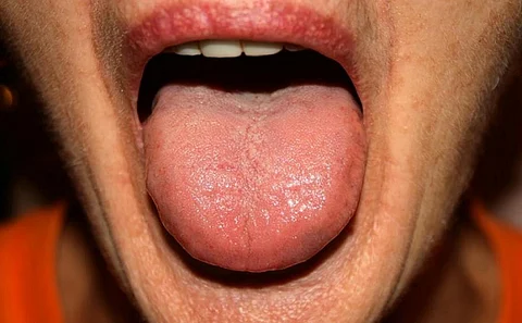 Candidiasis in the tongue. Notice the white coating. Photo: istock